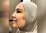 Wajah Tya Ariestya Kena 8 Jahitan Usai Terjatuh, Begini Kondisi Terbarunya