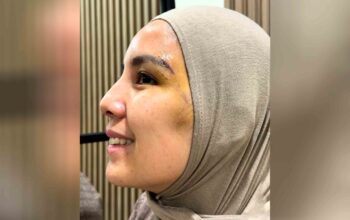 Wajah Tya Ariestya Kena 8 Jahitan Usai Terjatuh, Begini Kondisi Terbarunya