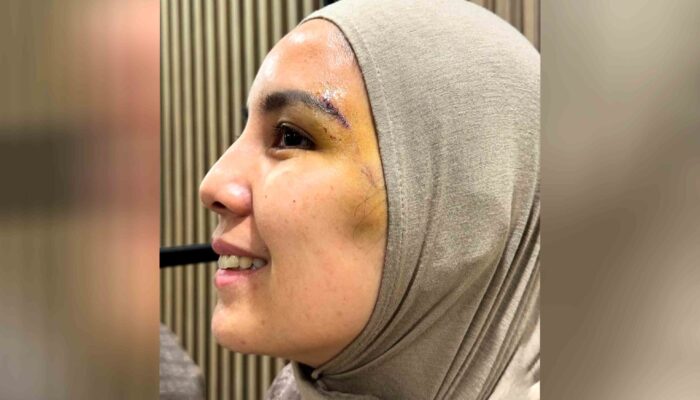 Wajah Tya Ariestya Kena 8 Jahitan Usai Terjatuh, Begini Kondisi Terbarunya